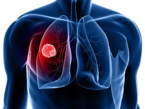 Image result for Lung Cancer Screening Software
