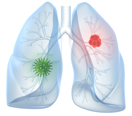 covid19 lung screening covid19 lung screening